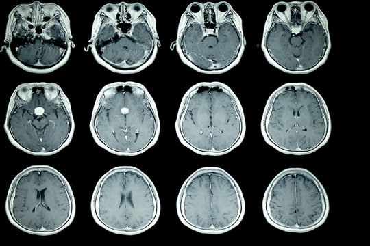 MRI scan of patient brain