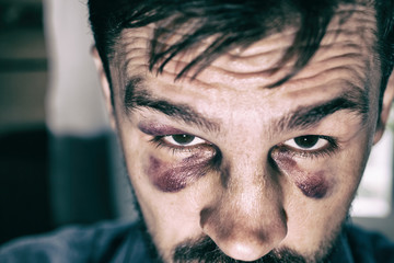 Man's face after the fight and assault. Caucasian male Emotional Portrait with a Real Bruise after...