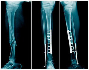 x-ray leg fracture with post operation internal fixation tibia bone