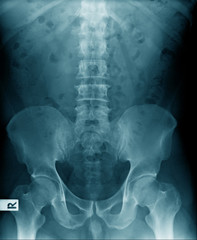 x-ray image of pelvic and part of femur bone, high quality pelvis and hip joint with part of lumbar...