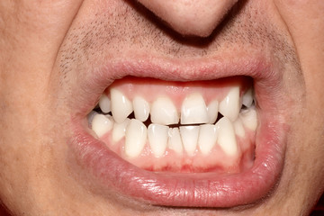Close-up portrait of man with crooked white ugly teeth, terrible smile. Dental problem, care and...