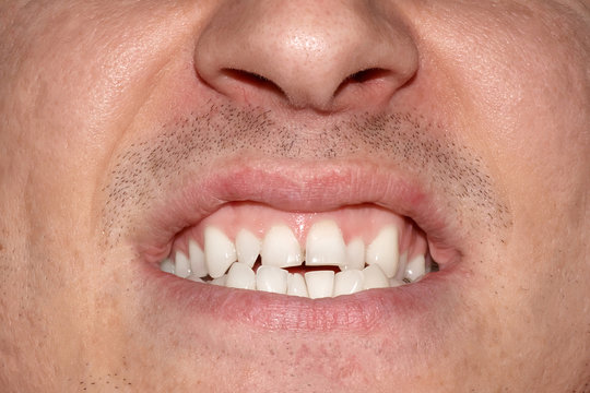 Close-up portrait of man with crooked white ugly teeth, terrible smile. Dental problem, care and toothache