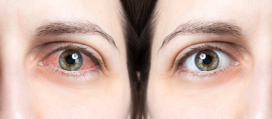 Red eye before and after using eye drops - obrazy, fototapety, plakaty