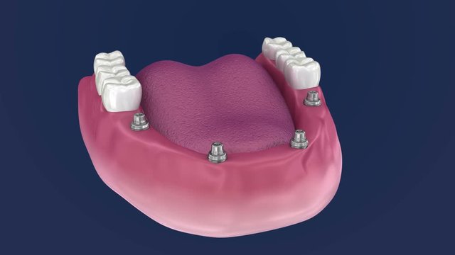 Overdenture to be seated on 4 implants - ball attachments. 3D Animation.