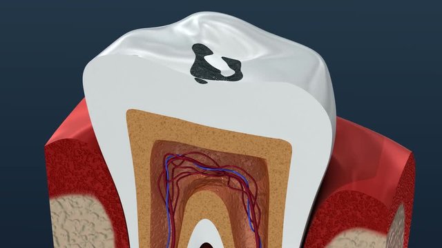 Root canal infection process. 3D Animation.