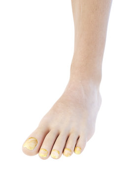 3d rendered, medically accurate illustration of toe nail fungus