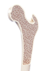3d rendered, medically accurate illustration of osteoporosis