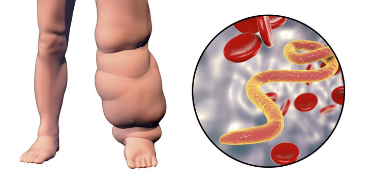 Leg of a person with elephantiasis, or lymphatic filariasis and close-up view of microfilariae in blood, 3D illustration. A disease caused by worms Wuchereria bancrofti, transmitted by mosquito bite