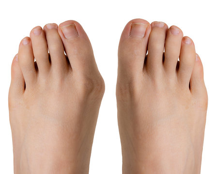 Hallux valgus before and after surgery