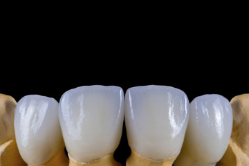 Ceramic teeth