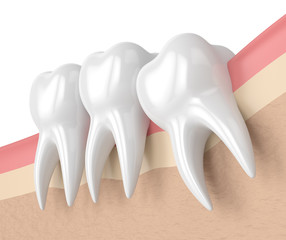 3d render of teeth with wisdom mesial impaction