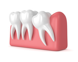 3d render of teeth with wisdom mesial impaction