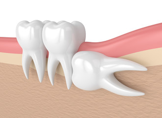 3d render of teeth with wisdom horizontal impaction