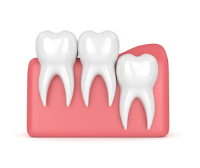 3d render of teeth with wisdom vertical impaction