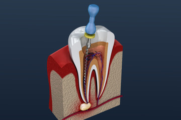 Root canal treatment process. 3D illustration