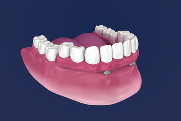 Overdenture to be seated on 4 implants - ball attachments. 3D illustration