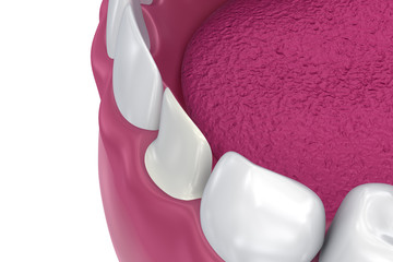 Dental Veneers: Porcelain Veneer installation Procedure. 3D illustration