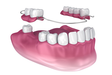 Removable partial denture. Medically accurate 3D illustration