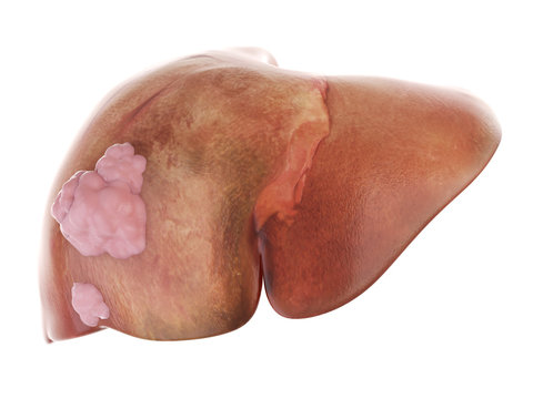 3d rendered, medically accurate illustration of liver cancer