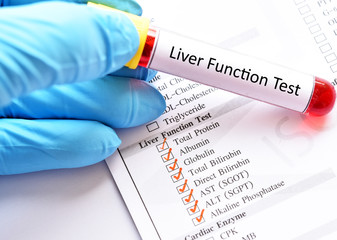 Blood sample for liver function test © jarun011