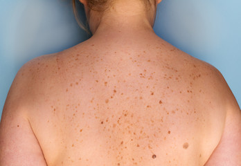 Closeup of freckles on back of a woman. Pigmentation and lot of birthmarks. Skin problems