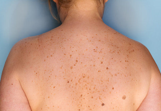 Closeup Of Freckles On Back Of A Woman. Pigmentation And Lot Of Birthmarks. Skin Problems