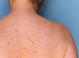Closeup of freckles on back of a woman. Pigmentation and lot of birthmarks. Skin problems