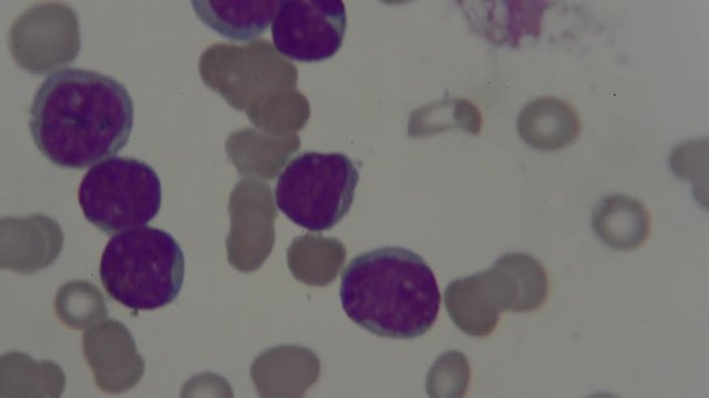 human blood smear under microscope , for analysis in laboratory 