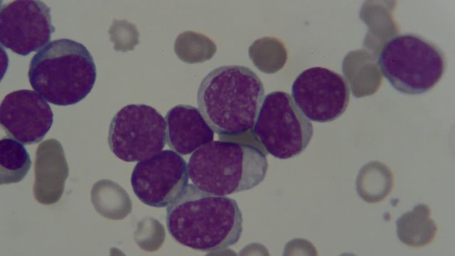 human blood smear under microscope , for analysis in laboratory 