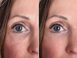 Woman With Before And After Rejuvenation