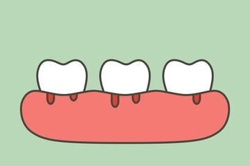 periodontitis or gum disease with bleeding ( blood flow come from gum and tooth ), dental problem
