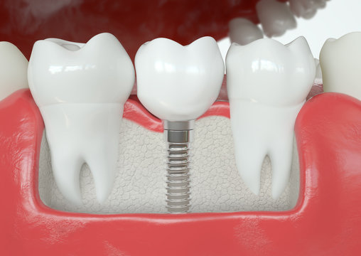 Healthy vs Tooth implant - 3D Rendering