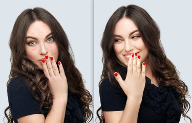 Post-Acne Marks /Treating Acne Scars.Acne Scar Removal