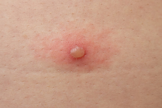 chickenpox or blister occurs on skin