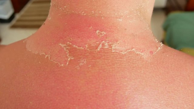 Sunburned man. Sunburned heavily, white skin versus very dark red and burned