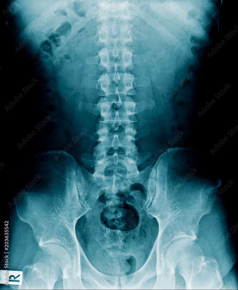 Sticker high quality x-ray of human spine show degenerative change of lumbar spine and mild spondylosis of thoracic spine and pelvic bone