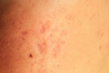 Fototapeta premium post-acne, scars and red festering pimples on the skin of the face. concept of skin problems and harmonic failure