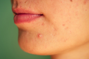 post-acne, scars and red festering pimples on the face of a young woman. concept of skin problems...