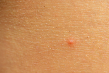 post-acne, scars and red festering pimples on the skin of the face. concept of skin problems and...