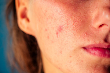 post-acne, scars and red festering pimples on the face of a young woman. concept of skin problems...