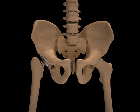 Human skeleton with a metal hip prosthesis concept arthroplasty 3d render isolated on a black