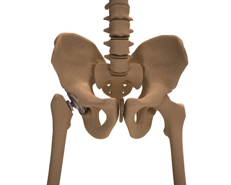 Human skeleton with a metal hip prosthesis concept arthroplasty 3d render