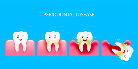 Step of periodontal disease. Healthy tooth and gingivitis. Dental care concept. Illustration isolated on blue background.