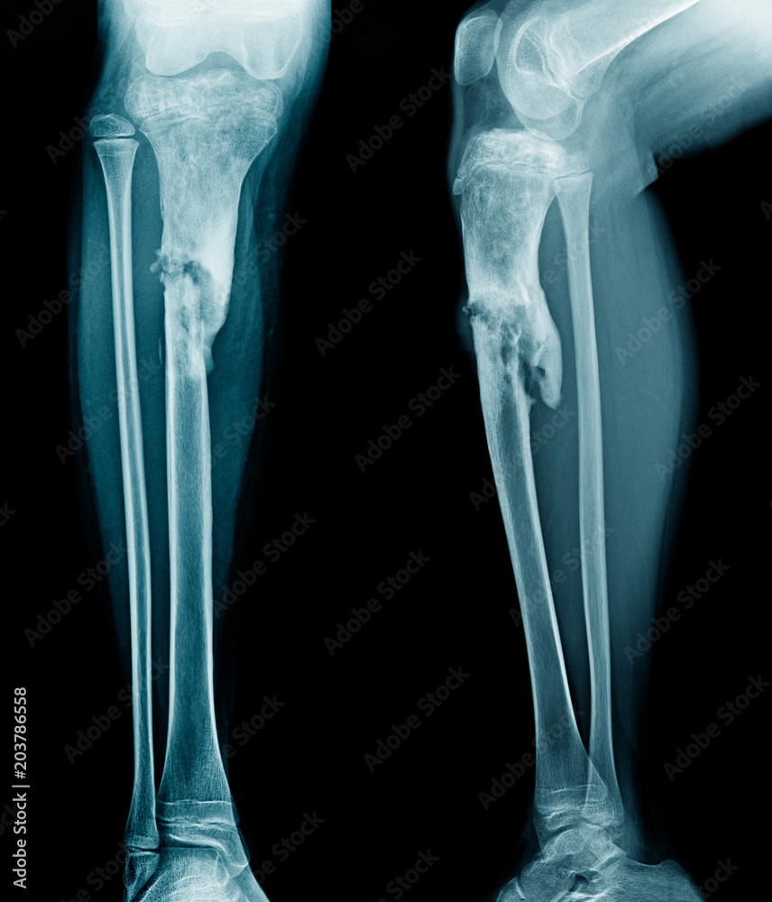 Canvas Prints x-ray leg of young person show osteomyelitis of tibia bone