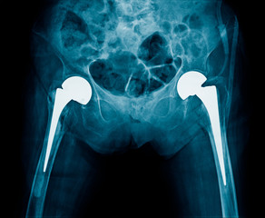 x-ray bilateral hip replacement, post operation total hip arthroplasty both side of old man