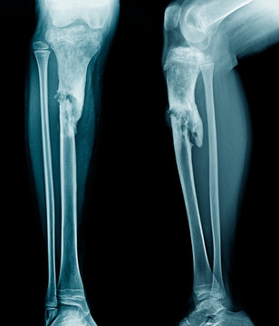 x-ray leg of young person show osteomyelitis of tibia bone