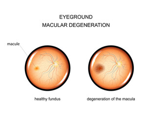eyeground. degeneration of the macula