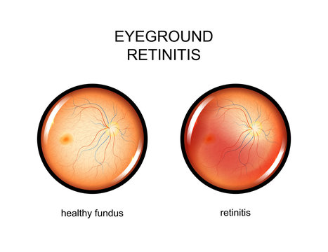 eye, fundus. retinitis