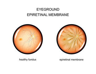 fundus. epiretinal membrane
