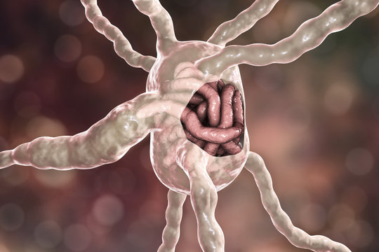 Lymph node with filaria worms, concept of elephantiasis, or lymphatic filariasis, 3D illustration. A disease caused by nematode worms Wuchereria bancrofti and other, transmitted by mosquito bite